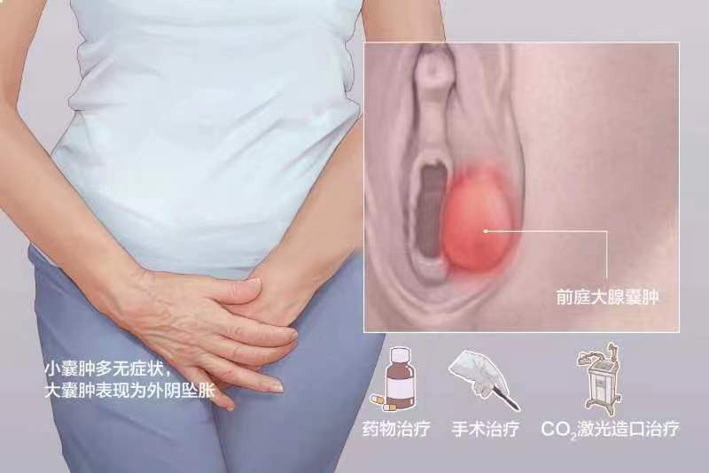 女性的难言之痛——前庭大腺脓肿 女性的难言之痛——前庭大腺脓肿