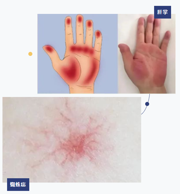 警惕! 这些信号可能是肝脏在"求救"… 警惕! 这些信号可能是肝脏在"求救"…