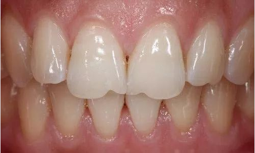 小牙齿为什么呈锯齿状? 小牙齿为什么呈锯齿状?