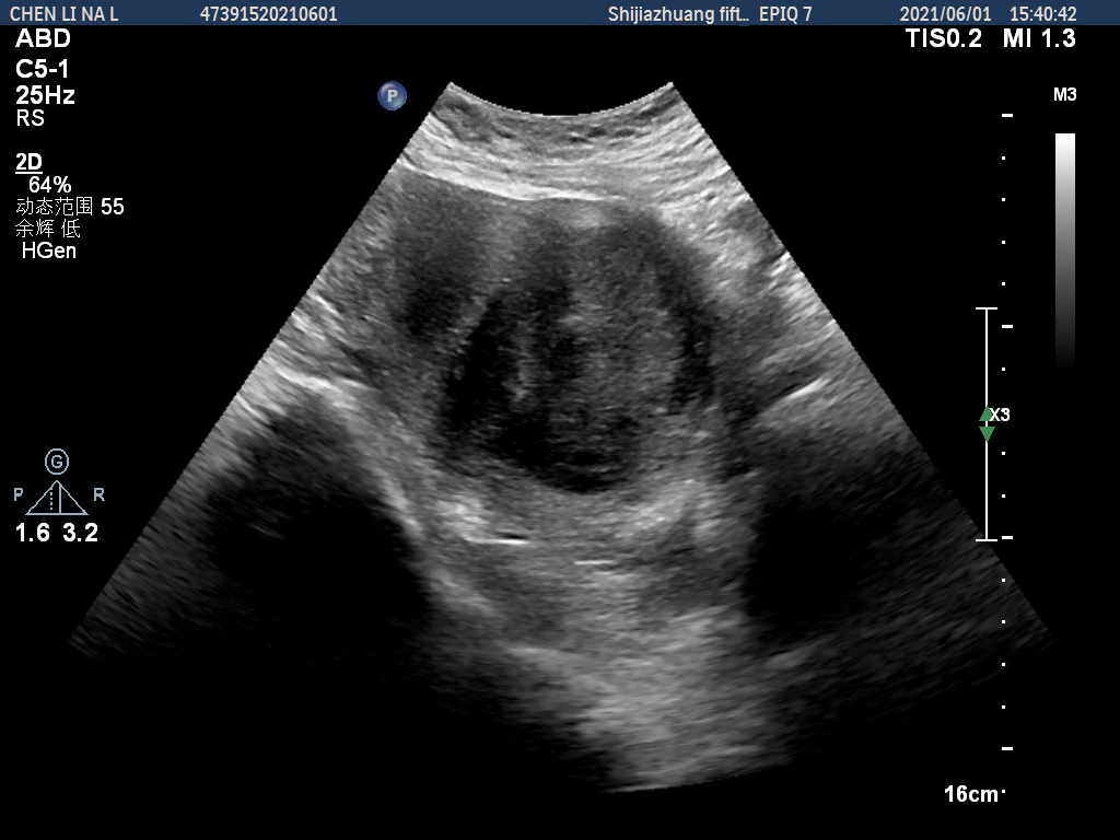 子宫肌瘤等良性病变的微创消融治疗