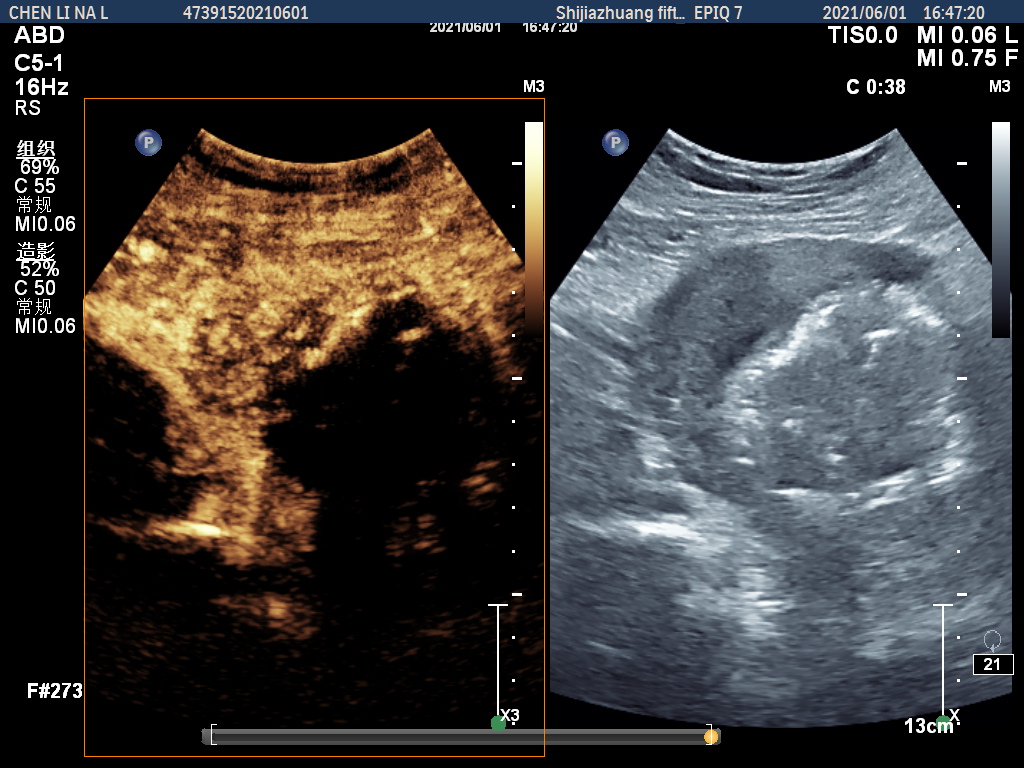 子宫肌瘤等良性病变的微创消融治疗