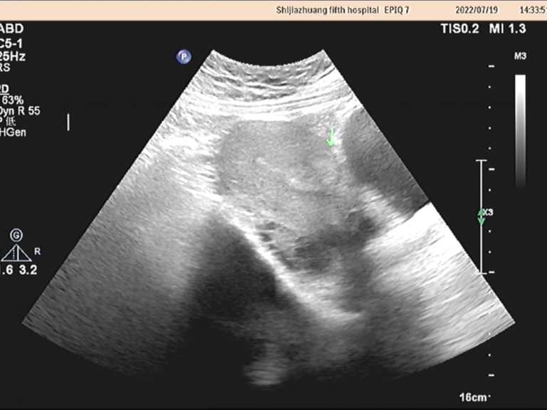 子宫肌瘤等良性病变的微创消融治疗