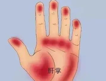 肝脏病变,皮肤先知!这五大肝病信号要注意了! 肝脏病变,皮肤先知!这五大肝病信号要注意了!