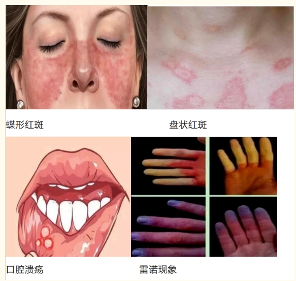 周海媚长期受“红斑狼疮”困扰,市五院专家为您揭开“红斑狼疮”的神秘面纱! 周海媚长期受“红斑狼疮”困扰,市五院专家为您揭开“红斑狼疮”的神秘面纱!