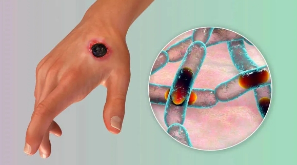 养殖场发现炭疽病例!炭疽是什么病?如何预防?一文带您读懂炭疽! 养殖场发现炭疽病例!炭疽是什么病?如何预防?一文带您读懂炭疽!