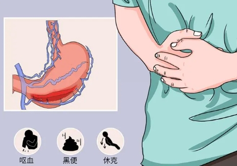 五院专家讲堂 | 上消化道出血的预防和治疗 五院专家讲堂 | 上消化道出血的预防和治疗