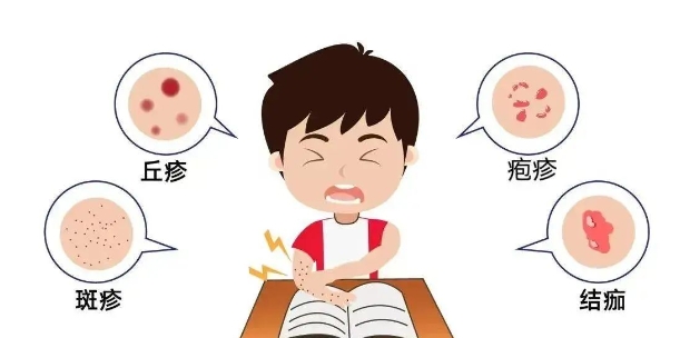 水痘大揭秘：别让错误认知耽误健康防护