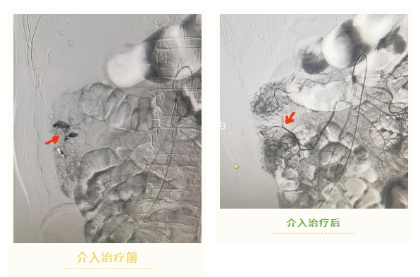 石家庄市第五医院多学科联合成功救治结肠憩室侧壁出血患者