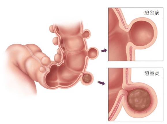 石家庄市第五医院多学科联合成功救治结肠憩室侧壁出血患者