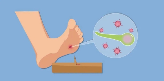 小伤口引发大危机!石家庄市第五医院成功救治一例重症破伤风患者! 小伤口引发大危机!石家庄市第五医院成功救治一例重症破伤风患者!