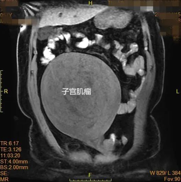 22cm 特大子宫肌瘤困扰多年，市五院妇产专家一朝手术化险为夷