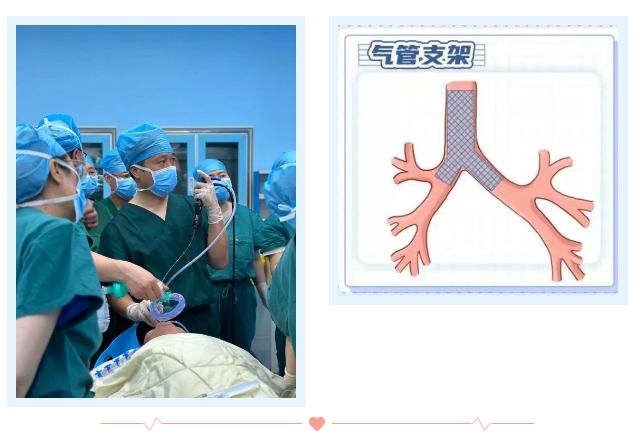 主气道狭窄,生命垂危!市五院专家妙手实施气管支架植入术 为患者打通呼吸通道 主气道狭窄,生命垂危!市五院专家妙手实施气管支架植入术 为患者打通呼吸通道