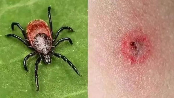 五院专家讲堂 | 小心!户外活动,谨防蜱虫叮咬 五院专家讲堂 | 小心!户外活动,谨防蜱虫叮咬