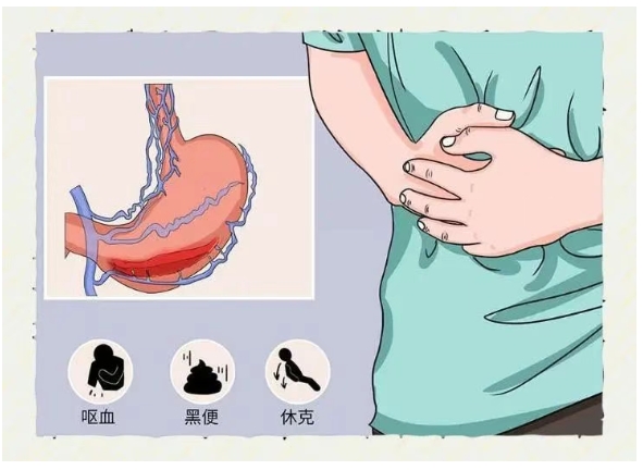 五院专家讲堂 | 消化道出血的前因后果
